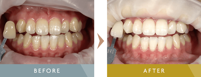 ホワイトニング治療例