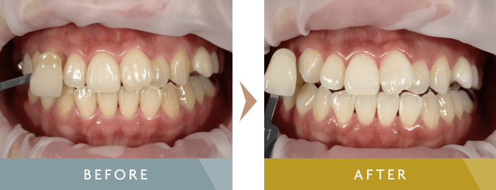 ホワイトニング治療例