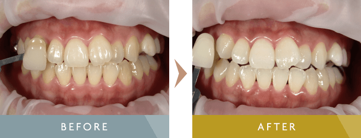 ホワイトニング治療例